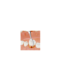 NSK INSERT ULTRASONIQUE P25R