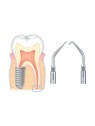 NSK PACK INSERTS ENDODONTIE RETROGRADE